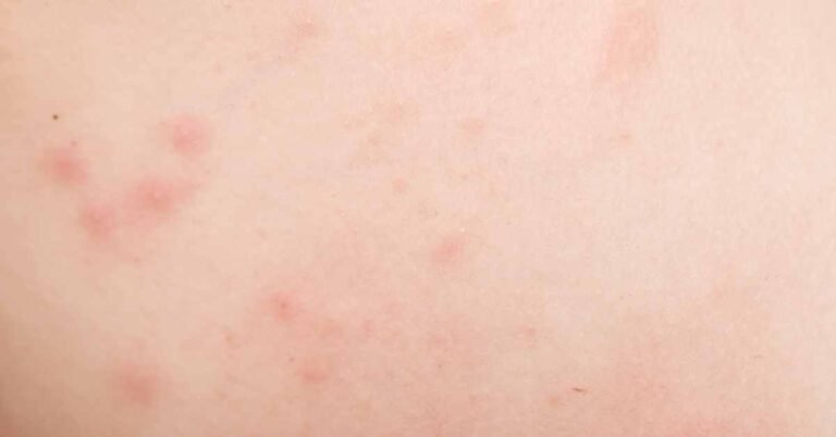 Covid 19 Rashes In Children- Everything You Need To Know – Doctoronhealth