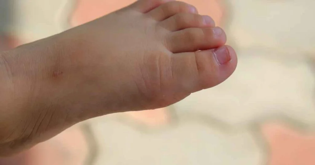 Covid 19 rashes in Children toe – DoctorOnHealth